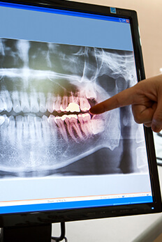 dentist pointing to x-ray