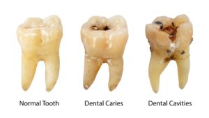 Your Pediatric Dentist in Greenfield Prevents Tooth Decay