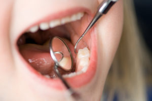 Dentist examining young child’s mouth